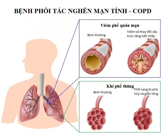 benh-phoi-tac-nghen-man-tinh-1